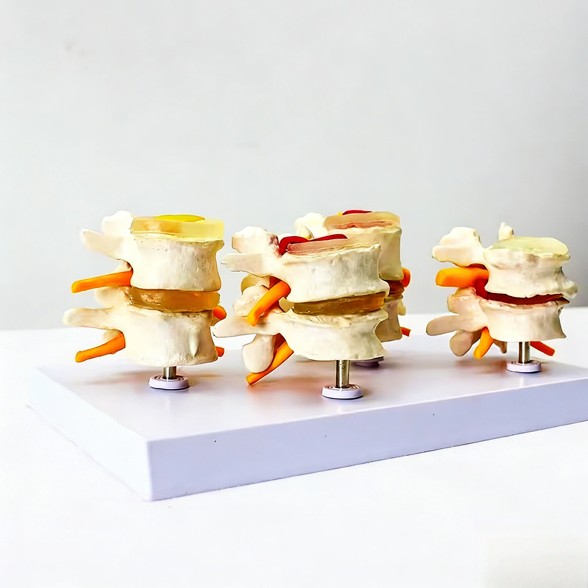 4-stages Pathological Human Lumbar Spine Anatomy Model Medical Science Teaching Resources
