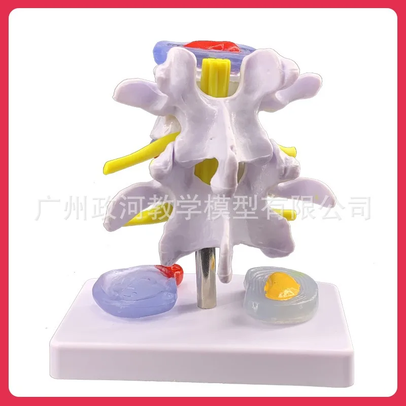 Human Lumbar Disc Herniation Anatomy Model Skeletal Pathology