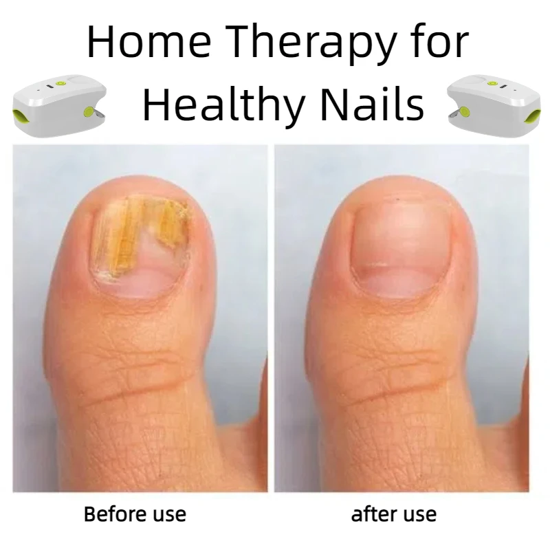 

Advanced Onychomycosis Treatment Device with Laser Technology for Nail Fungus Removal and Healthy Nail Regrowth