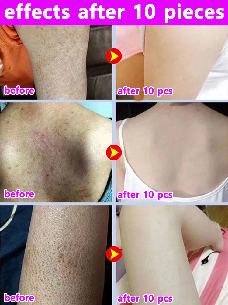 โลชั่นทาตัวขัดผิวซ่อมแซม Keratosis pilaris กำจัดขนลุกและขาสตรอเบอร์รี่