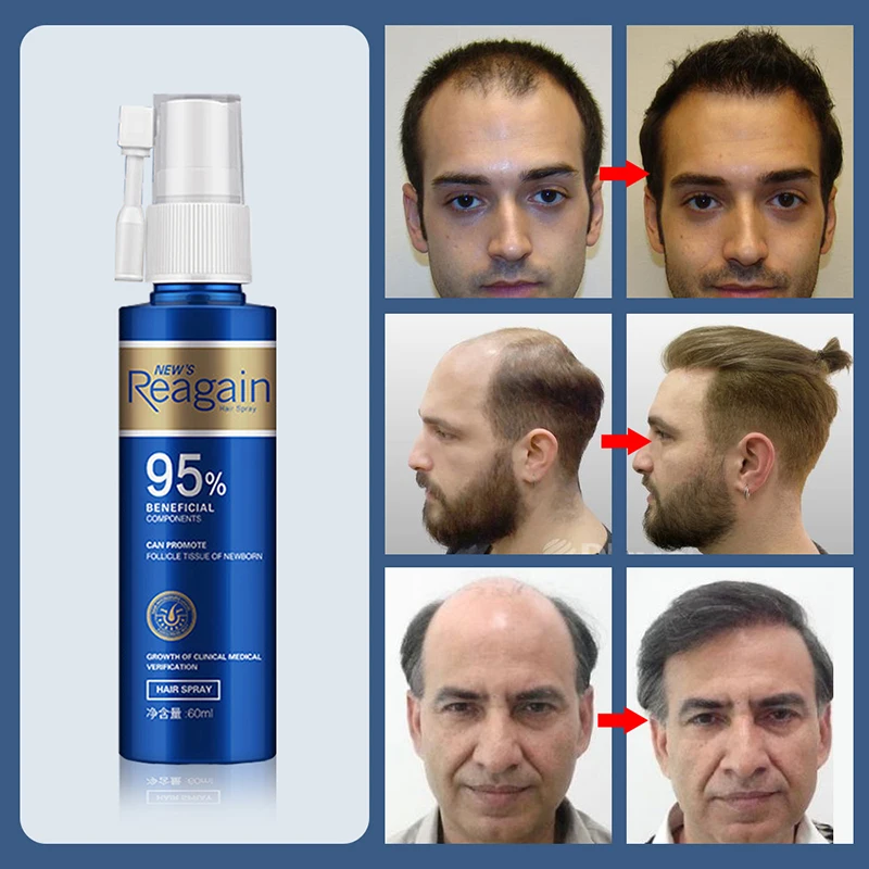 Anti Hair Loss Regrowth Essence Hair Growth Serum Sprayer Hair Regrowth For Men Rapid Growth Essence Prevent Hair From Falling