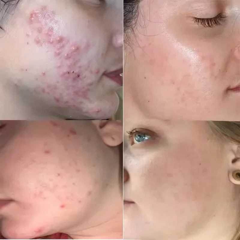 شجرة الشاي كريم إزالة حب الشباب الوجه ترطيب خفيف السيطرة على النفط حب الشباب إزالة هلام الوجه القضاء على حب الشباب البثور الصحة الجمال