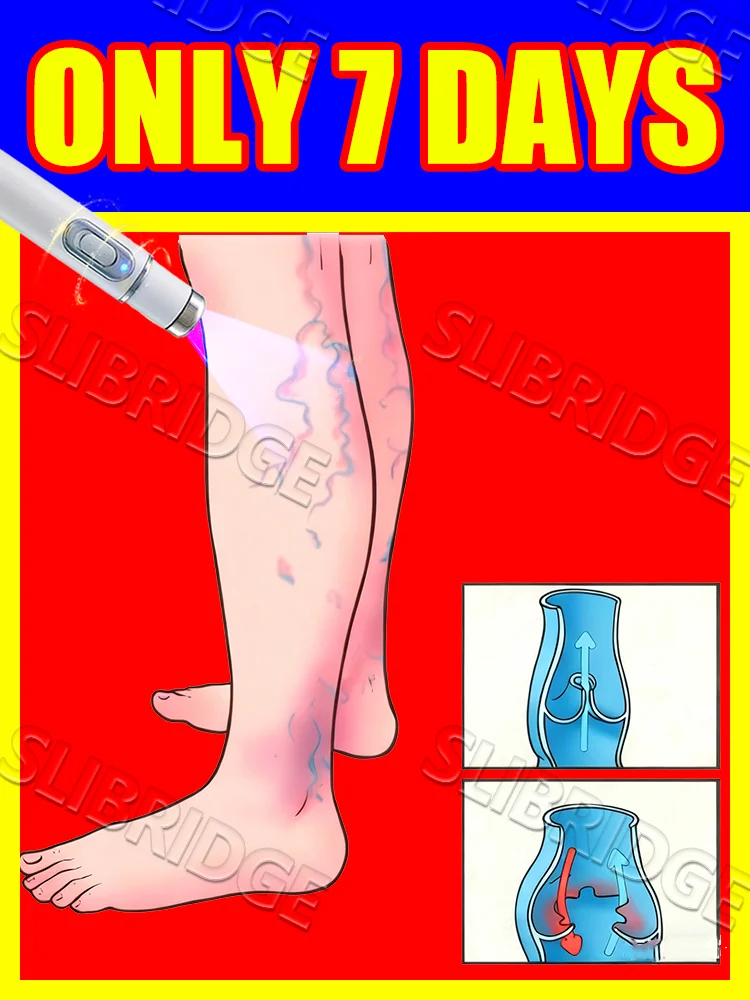 

blue light pen solve veins,veins care tools,Regain the confidence of effortless steps,free shipping