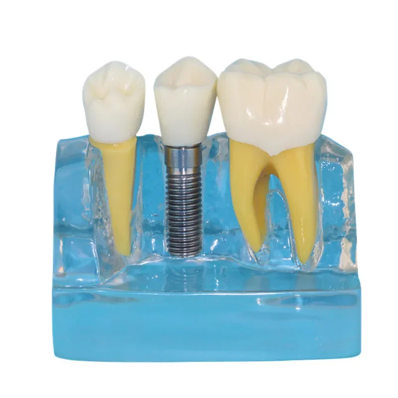 Model Gigi Mulut Manusia, Model Gigi Transparan, Model Implan Gigi