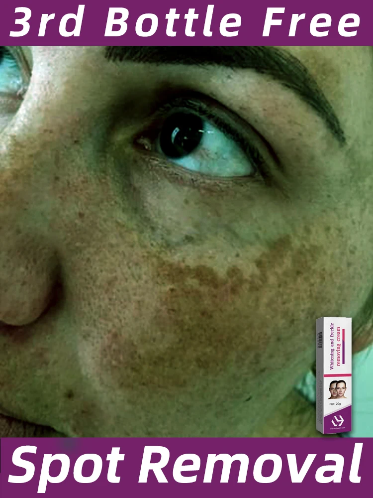 

Facial skin Care Freckles Cream Dark Spot