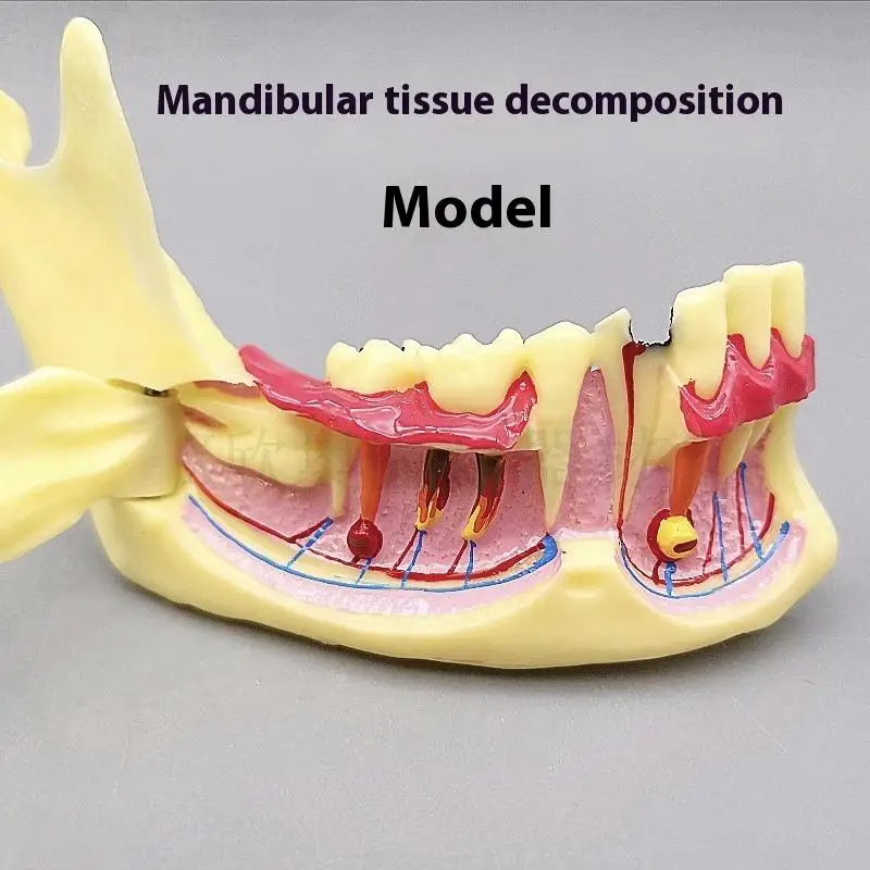 Modelo anatômico de tratamento endodôntico dental, tecido mandíbula de goma para dentista, ensino, estudo, modelo de dentes de demonstração