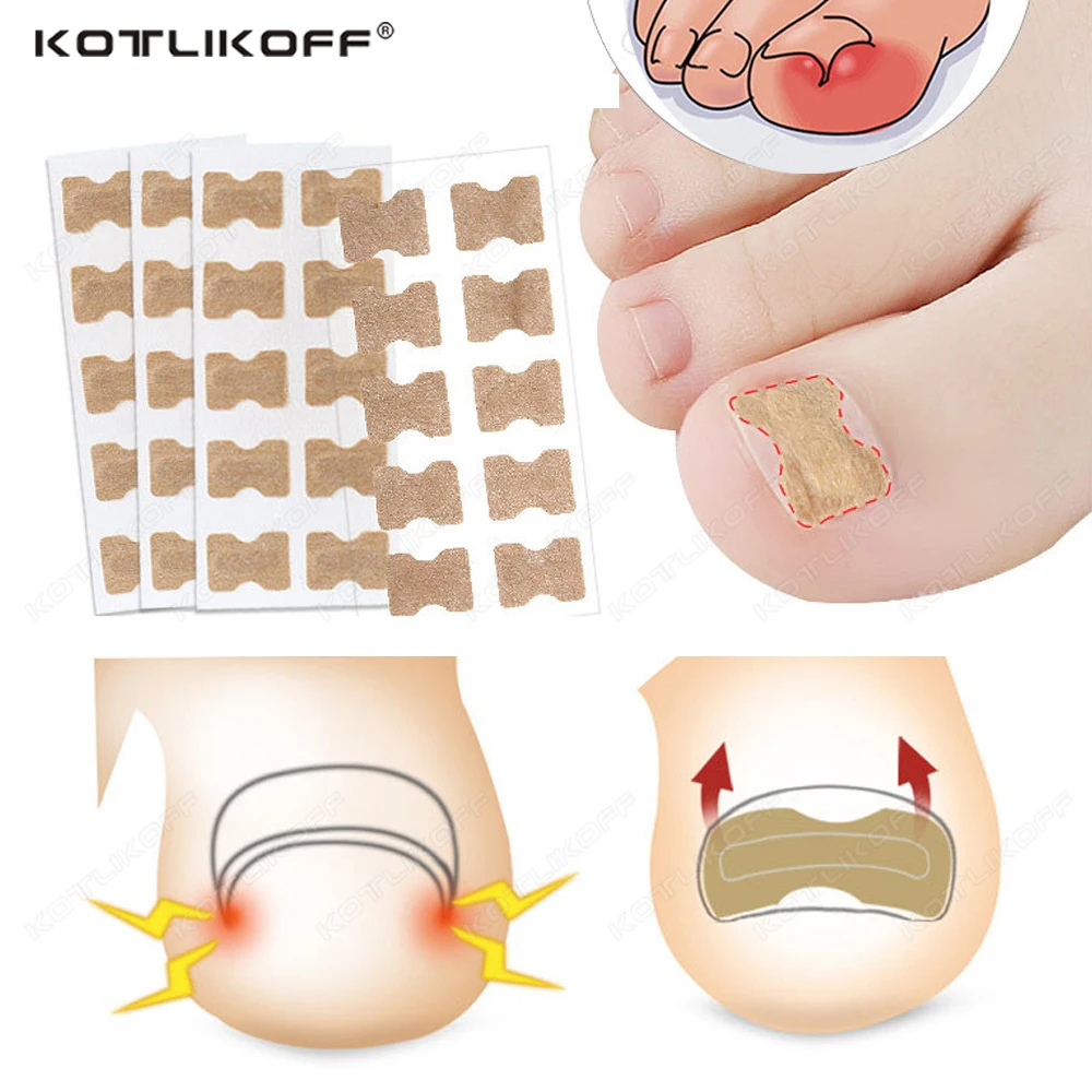 Nail Correction Stickers Ingrown Toenail Corrector Patches Paronychia Treatment Recover Corrector Pedicure Tools 10/20/30/50PCS