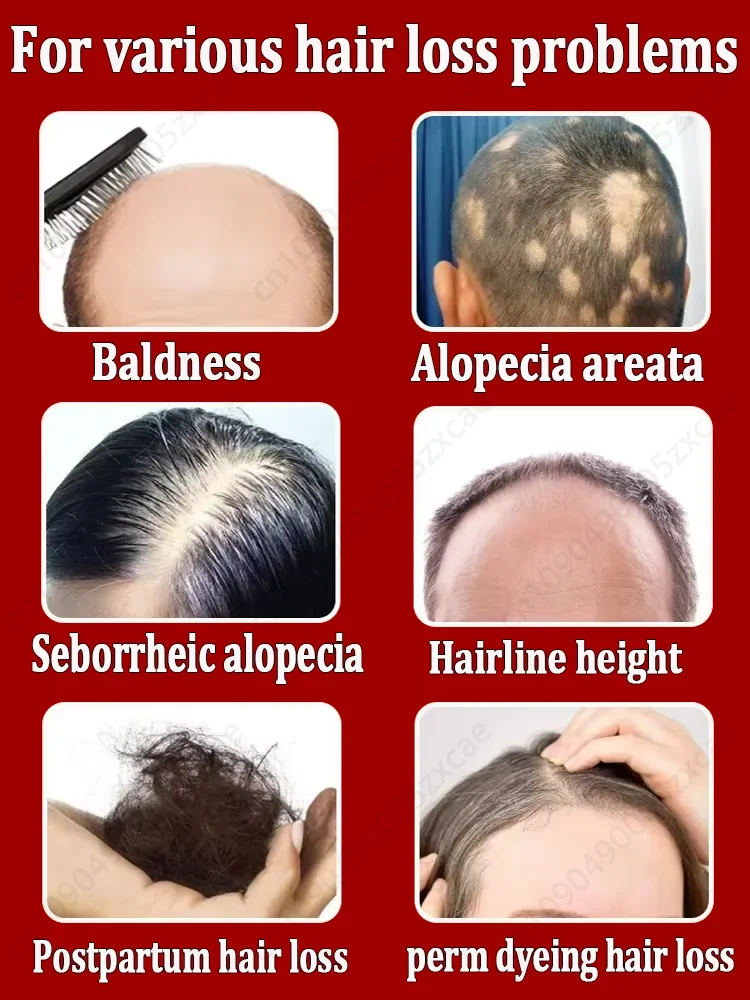 【Vendita calda ufficiale】 Esporta certificato autoritativamente, più e più capelli, dirige addio alla calvizie, capelli spessi, cura dei capelli, provid