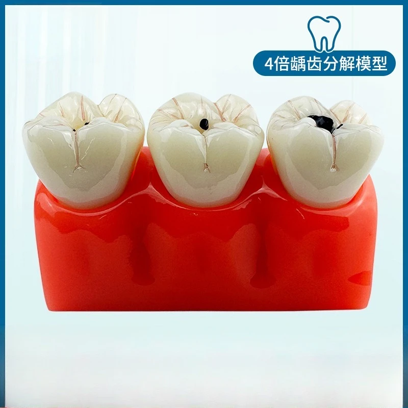 Red 4x caries decomposition model teaching tooth model detachable observation neurodental learning model