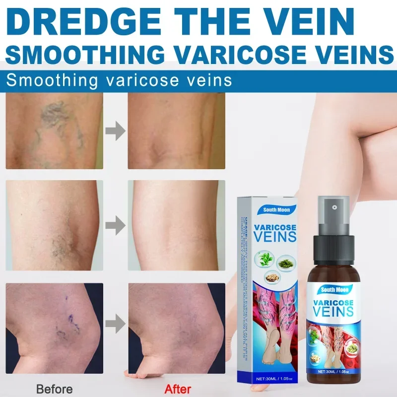 Spray for varicose veins Effective varicose vein relief cream to relieve Leg vasculitis phlebitis spider pain swelling treatment