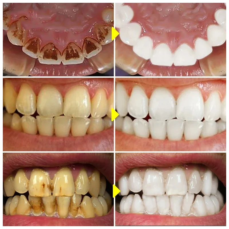 Pasta de dientes morada V34, enzima blanqueadora, elimina las manchas de placa, higiene bucal, herramientas dentales, aliento fresco 2024