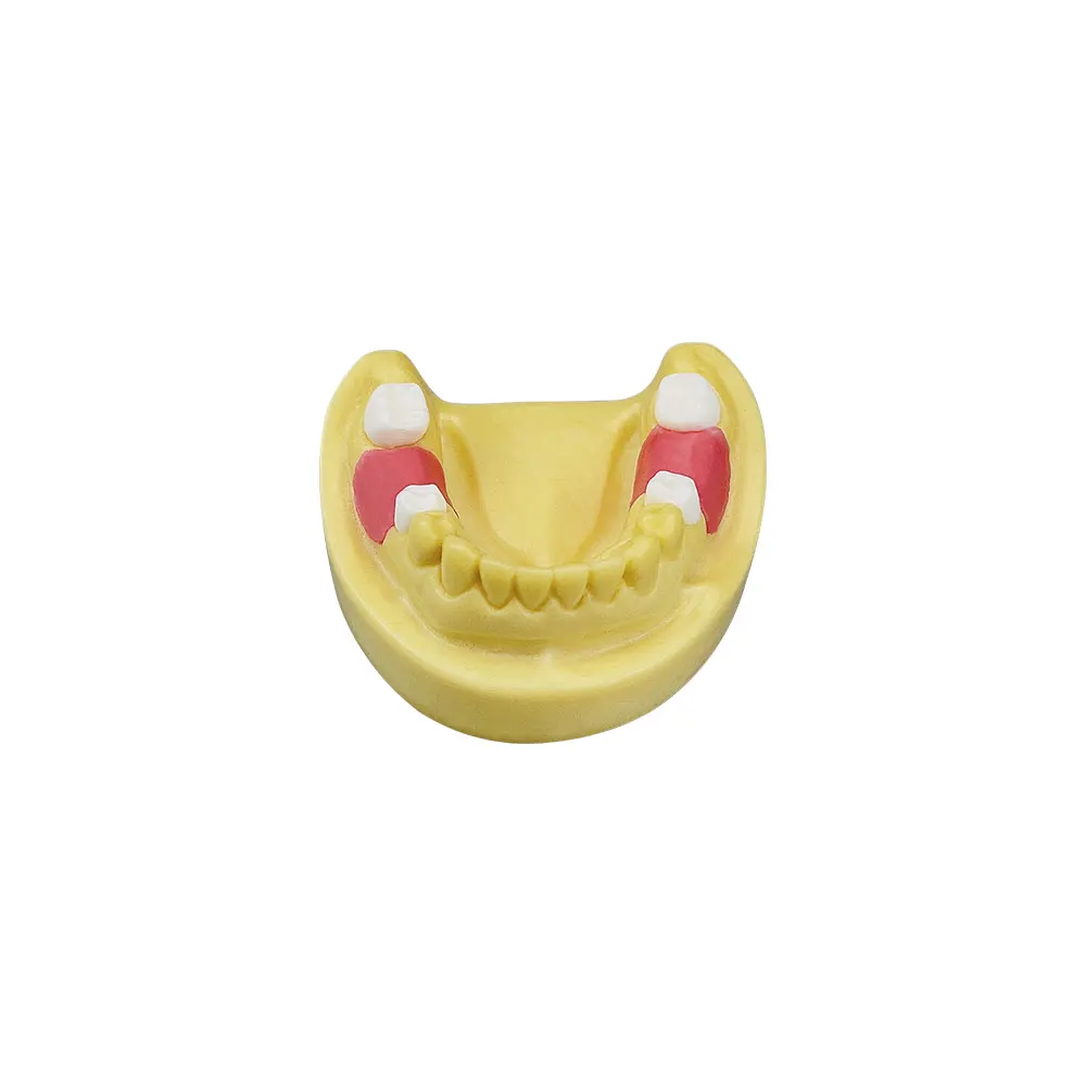 1pc Lower Jaw Teeth Model Dental Practice Model Implant Model Missing Tooth For Training Studying Education Teaching Display New