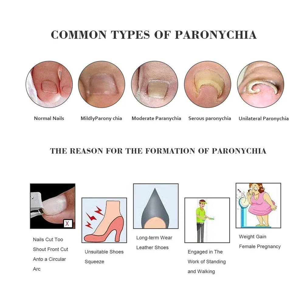 1 par de mangas corretoras de unhas encravadas em gel, protetor de cuidados de cura de unhas do dedo grande, paroníquia, alívio da dor, tratamento, ferramenta de pedicure