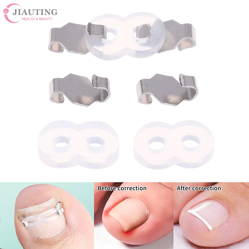 1/2Set Strumenti per la correzione dell'unghia del piede incarnita in acciaio inossidabile Pedicure Recupera incorporare il trattamento dell'unghia del piede Strumento di correzione professionale per la cura del piede