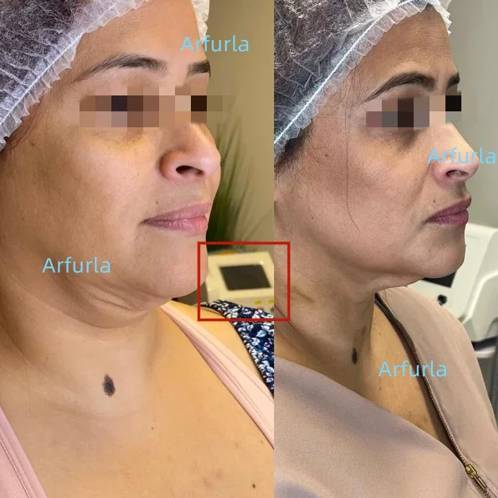 Fibra per lipolisi SMA 905 fibra di consumo medica 400um