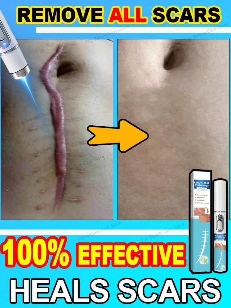 Scar laser products 𝑄𝑢𝑖𝑐𝑘 𝑠𝑐𝑎𝑟 𝑟𝑒𝑚𝑜𝑣𝑎𝑙