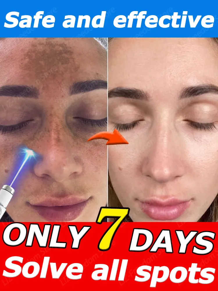 

Highly effective freckle repair facial sunburn dark spot