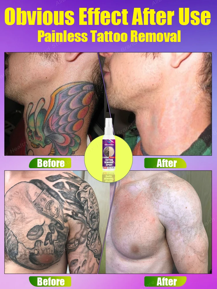 Tattoo Removal Cream Best Sell Suitable For Large Indelible Old Permanent Tattoos Removal