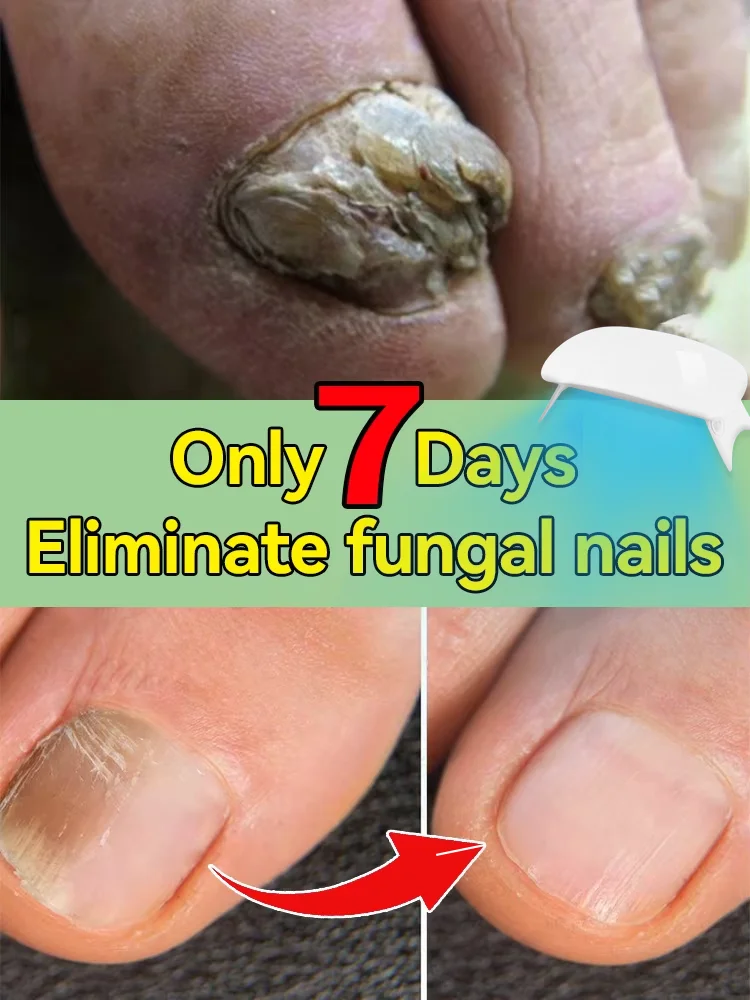 Solves Nail troubles