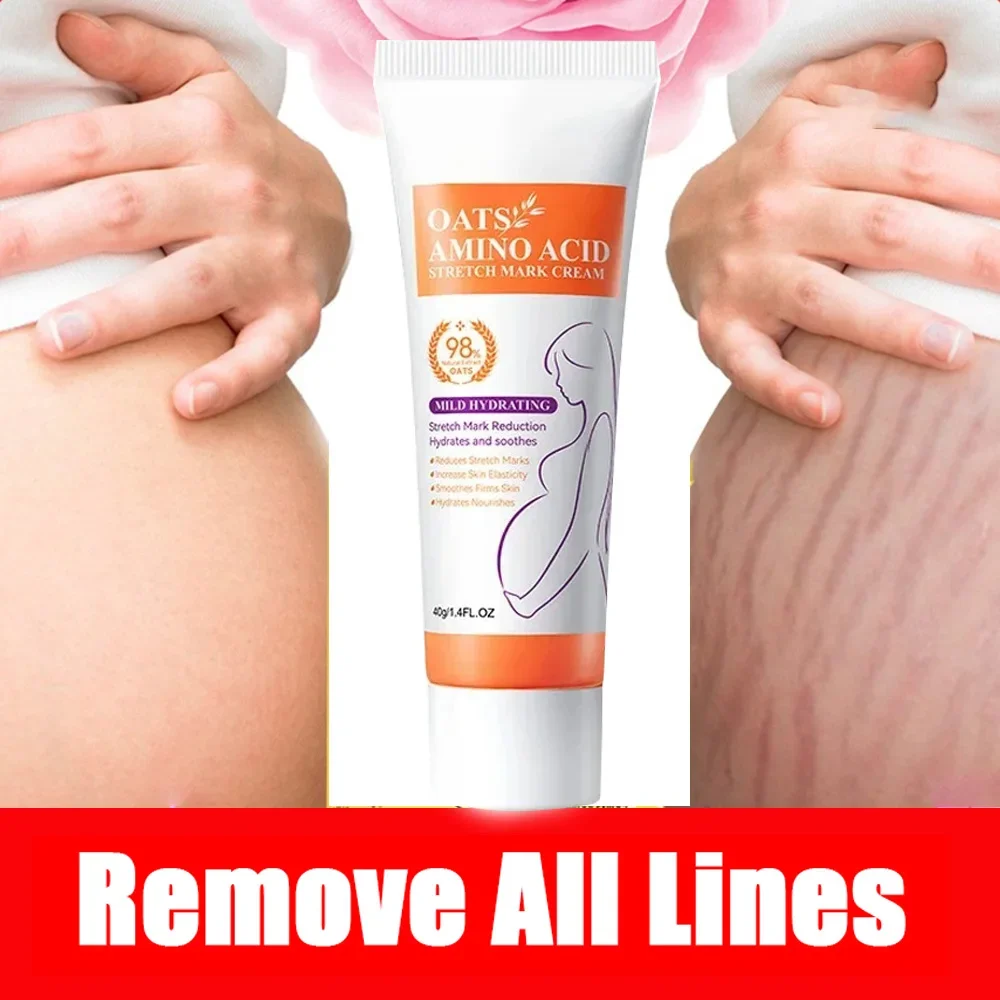 

Scar Stretch Marks Cream Repair cream Removal Acne Scar Stretch Marks Cream Fat Scar Striae Treatment Body Creams