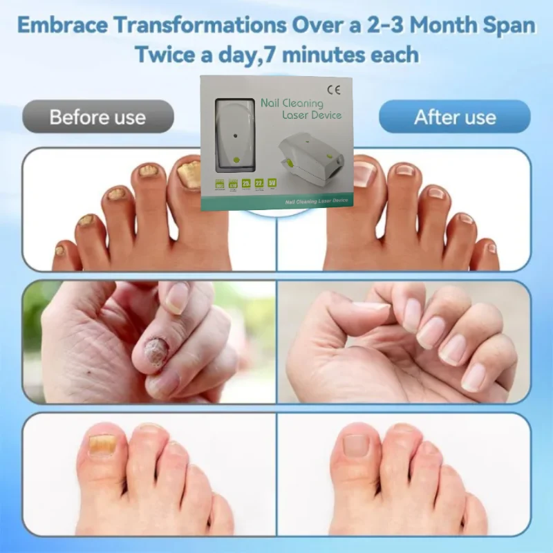 

Onychomycosis Infrared Laser Nail Fungus Treatment Device - Effective & Non-Invasive Care