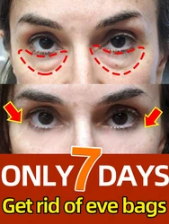 Solve the Eye bags problem