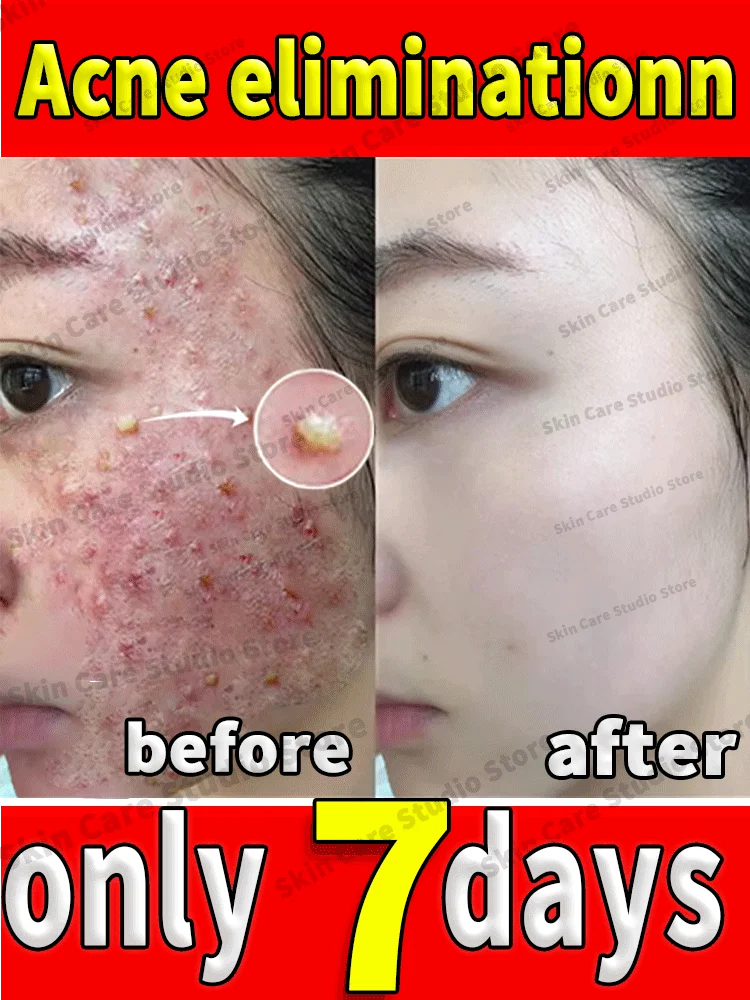 

acne remover cream For anti face pimples serum