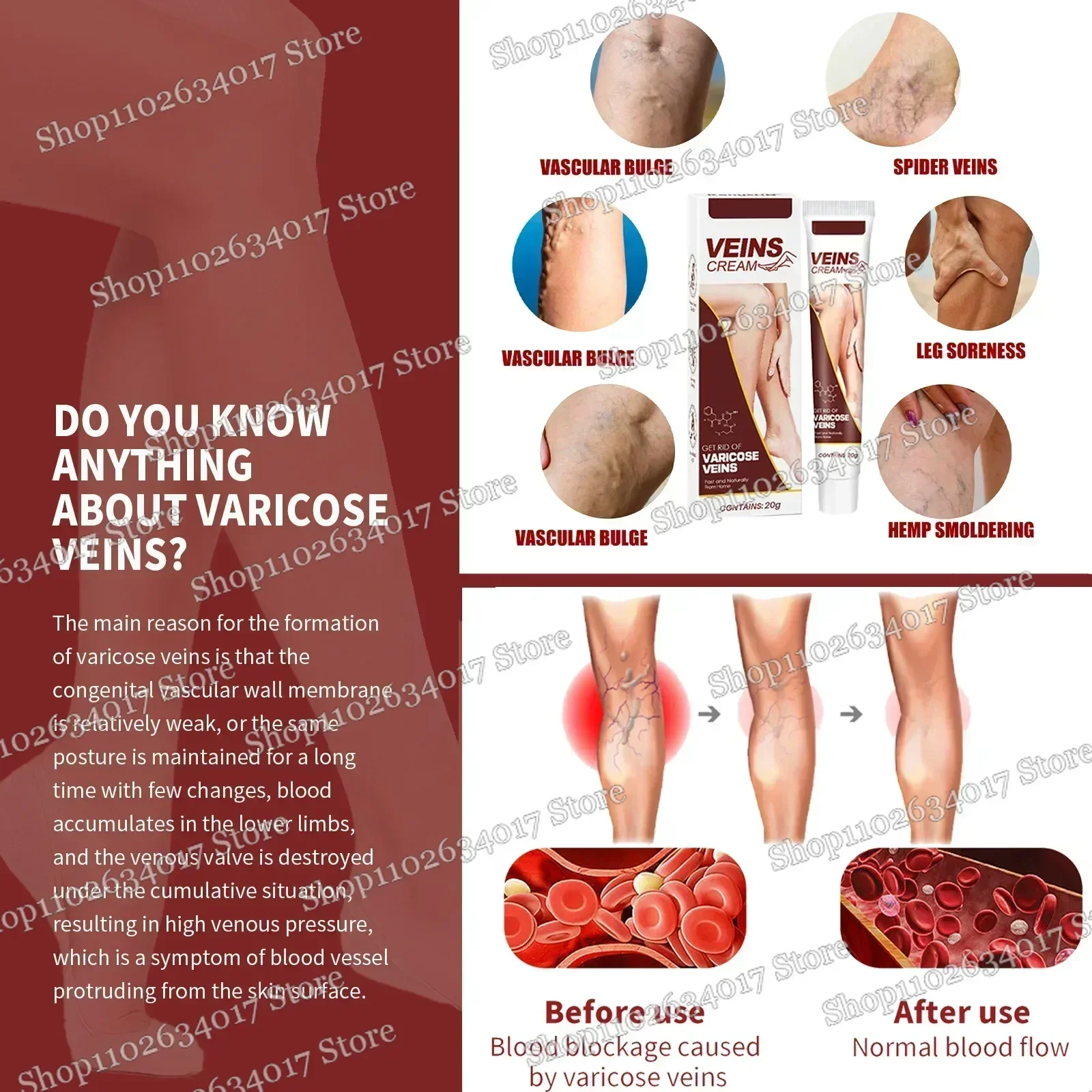 ใหม่ Original Vasculitis การไหลเวียนโลหิตเส้นเลือดขอด Treatment ครีมใหม่ 20g