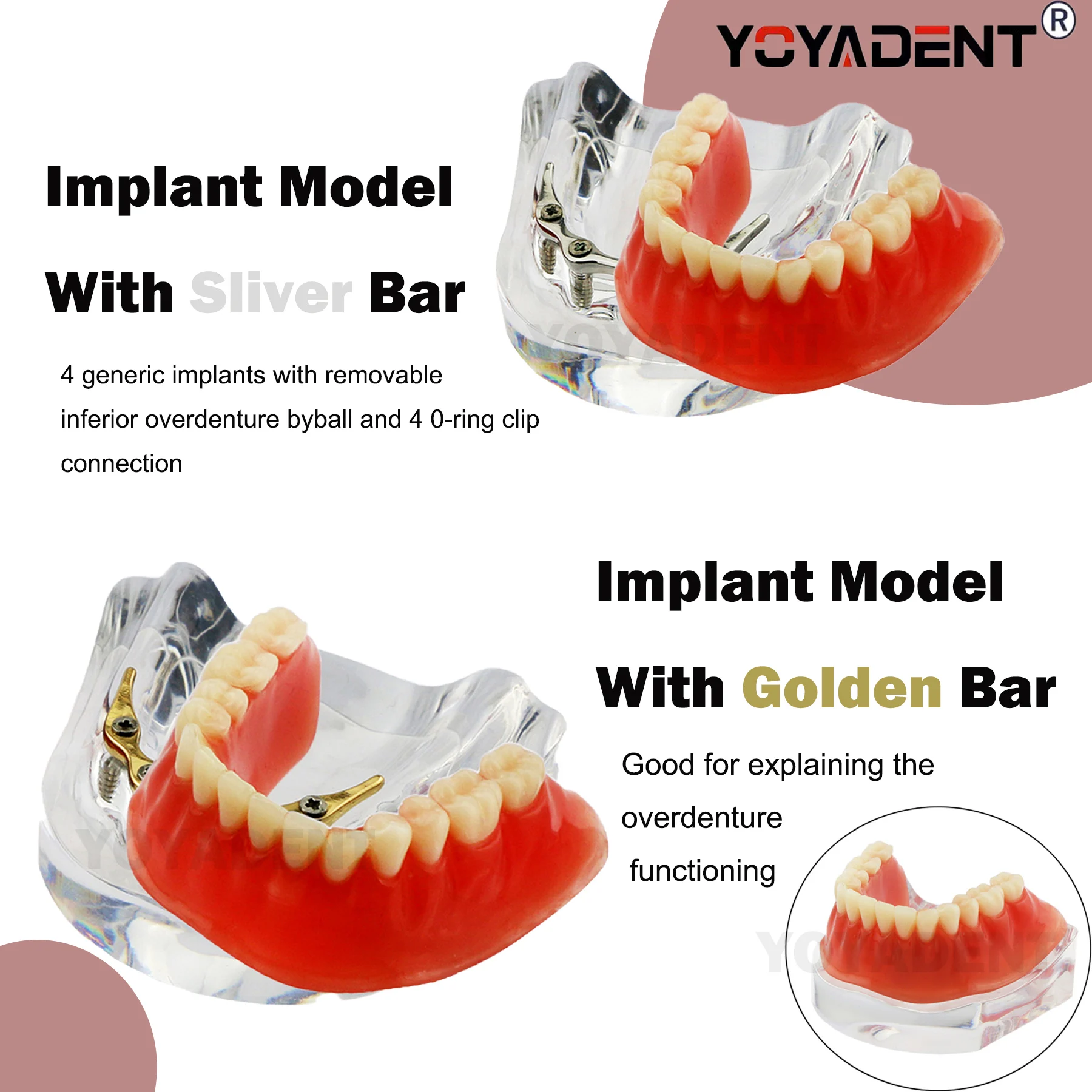 

Dental Implant Teeth Model Removable Overdenture Model 4 Implants Lower Restoration Treatment For Dentistry Demo Study
