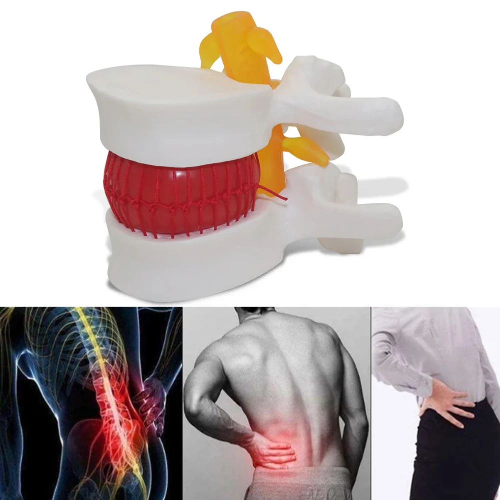 Medical Props Model Free postage Anatomical Spine Lumbar Disc Herniation Anatomy Medical Teaching Tool Slipped Disc