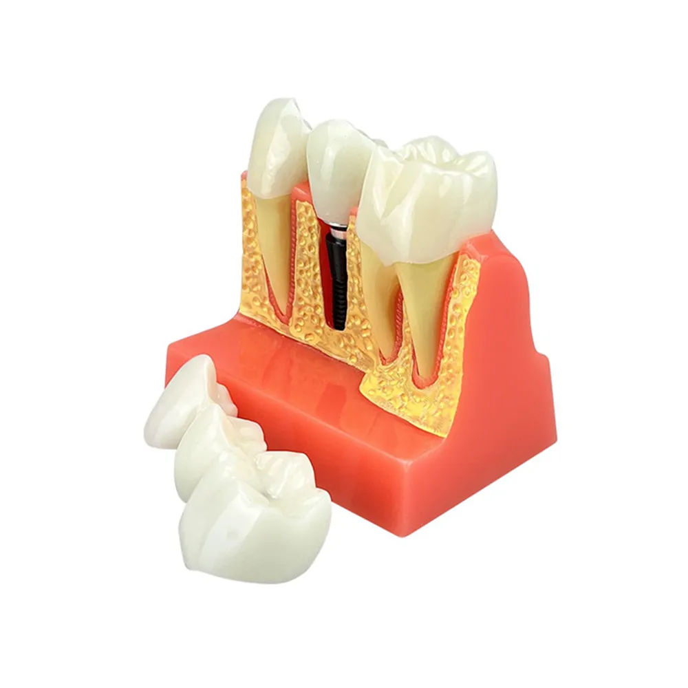 Diş Implant modeli 4 kez Implant analizi taç köprüsü çıkarılabilir Model diş hekimliği gösteri diş çalışması Model beyin