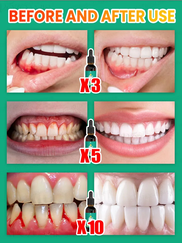 Eᴀsɪʟʏ ʀᴇɢᴇɴᴇʀᴀᴛᴇ ɢᴜᴍs ᴀɴᴅ ᴄᴏᴠᴇʀ ᴛᴇᴇᴛʜ ɪɴ 7 ᴅᴀʏs #2