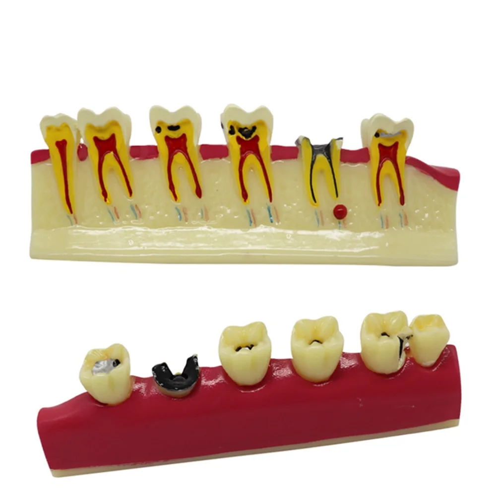 Periodontal Disease Model Dentistry Tooth Model Periodontitis Dental Teeth Model for Studying Teaching Education Demonstration