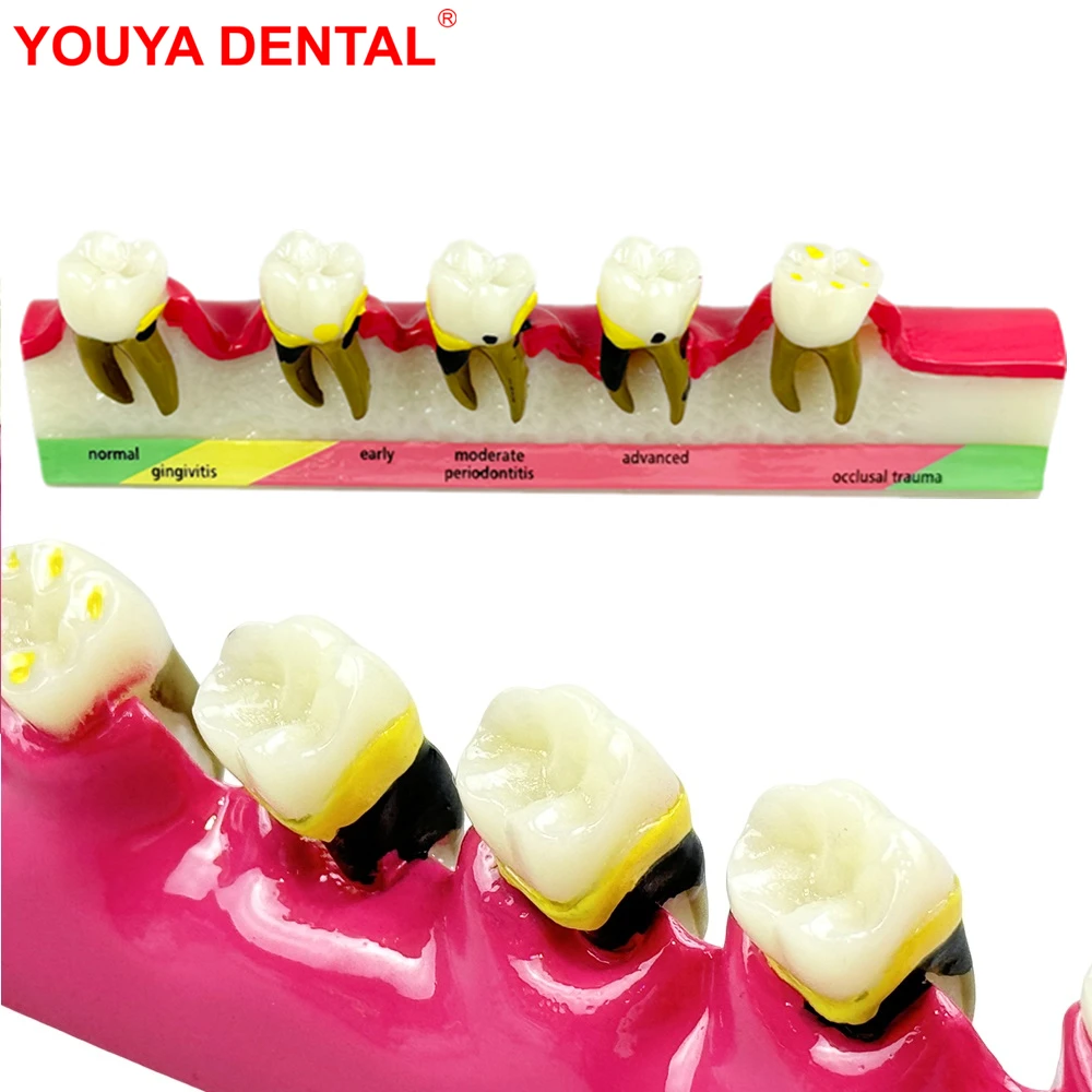 1PC Dental Periodontal Disease Model 5-Stage Perio Disease Assort Demo Typodont Caries Periodontitis Occlusal Trauma Teeth Model