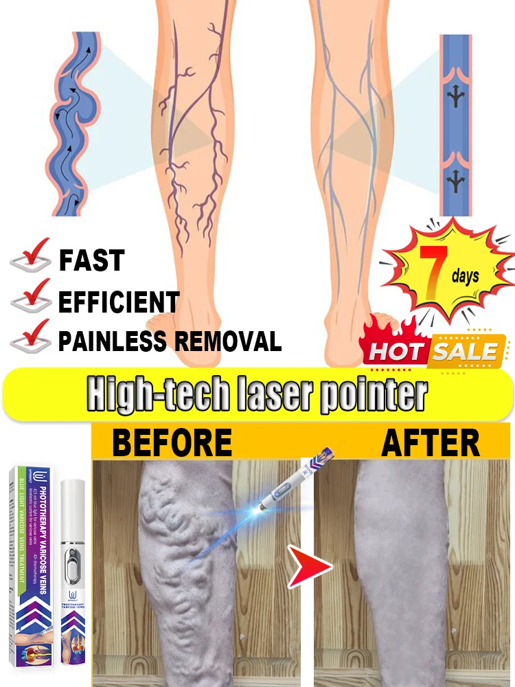 

Varicose Vein Treatmentfor Legs, Spider Veins Treatment for Legs