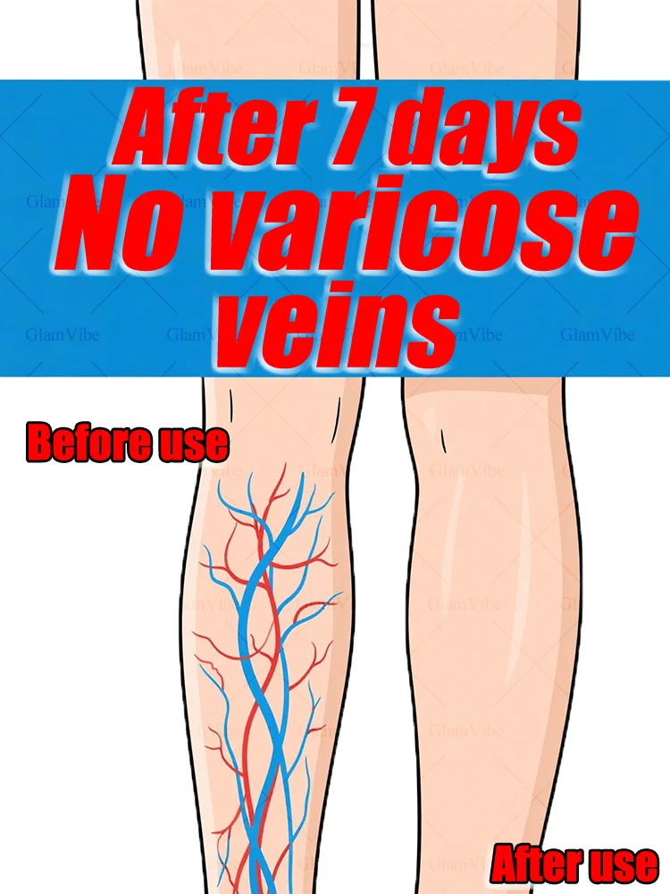 Intraveneuze laserintervention, bescherming van uw gezondheid