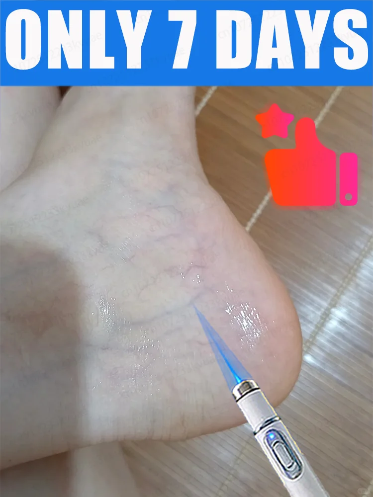 

2nd generation laser venous treatment pen, used to treat varicose veins