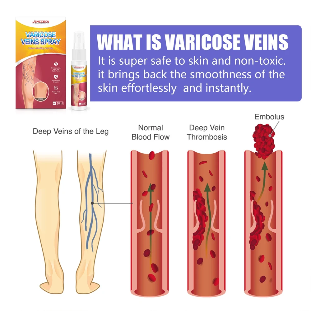 Jemeesen Varicose Vein Spray Relieve Legs Dilated Vasculitis Phlebitis Natural Formula Liquid For Varicose Veins Body Care 30ML