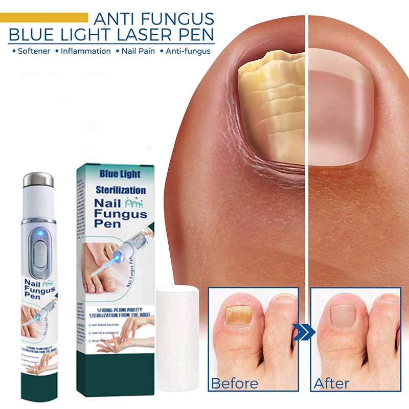 Fungus Care Repair Pen Anti Fungus Blue Light Repair Pen Onychomycosis Painless Removal Foot Repair Products Laser Pointer