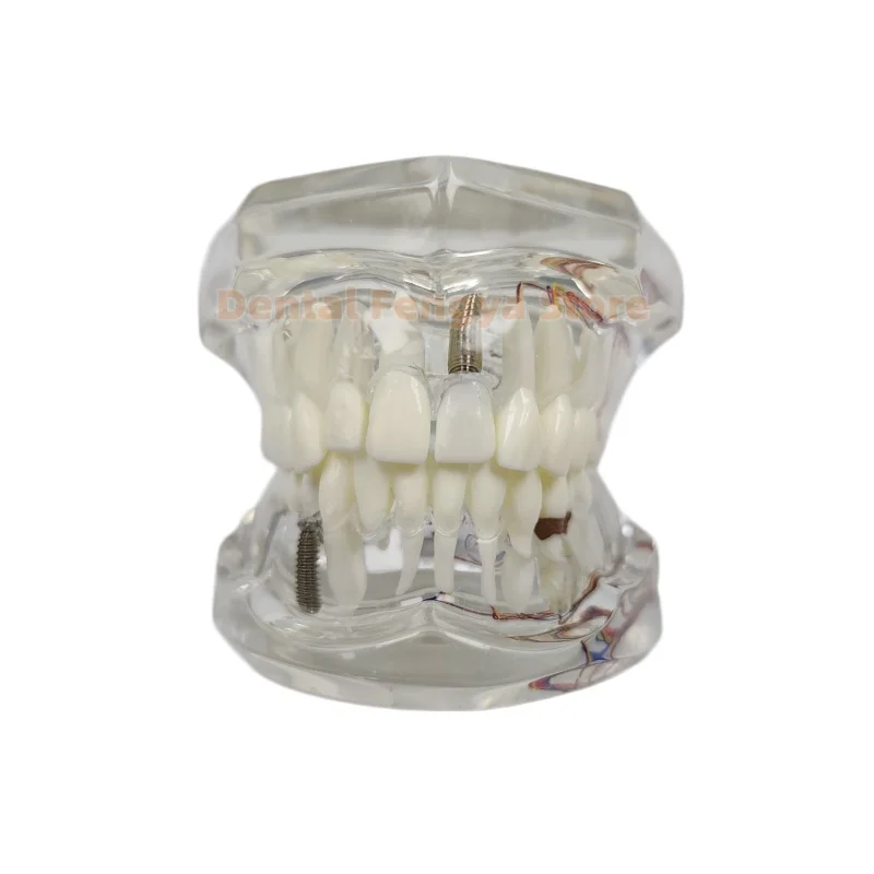 Transparent Dental Implant Teeth Neural Repair Pathological Model Dentist Students Communication Teaching Study Model