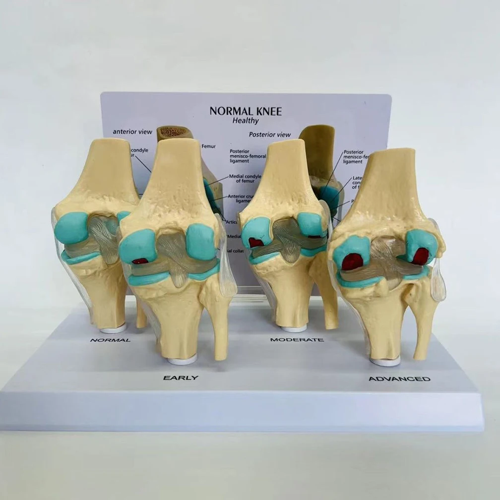 

4-stage Knee Joint Disease Model Anatomical Human Degenerative PVC Bone Medical Skeleton Anatomy Teaching Resources ﻿Wholesale