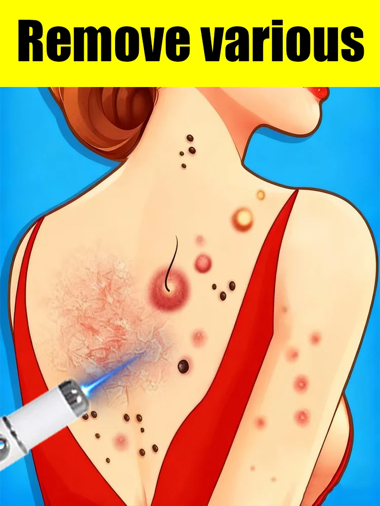 تستخدم أدوات مؤشر الليزر لعلاج أنواع مختلفة من الثآليل في جميع أنحاء الجسم.