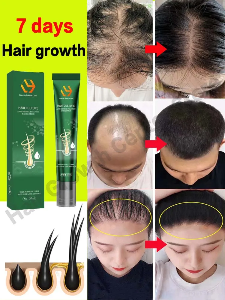 Hair Growth Oil Fast Hair Growth Effective Baldness Repair Hereditary Hair Loss Postpartum Hair Loss Seborrheic Hair Loss