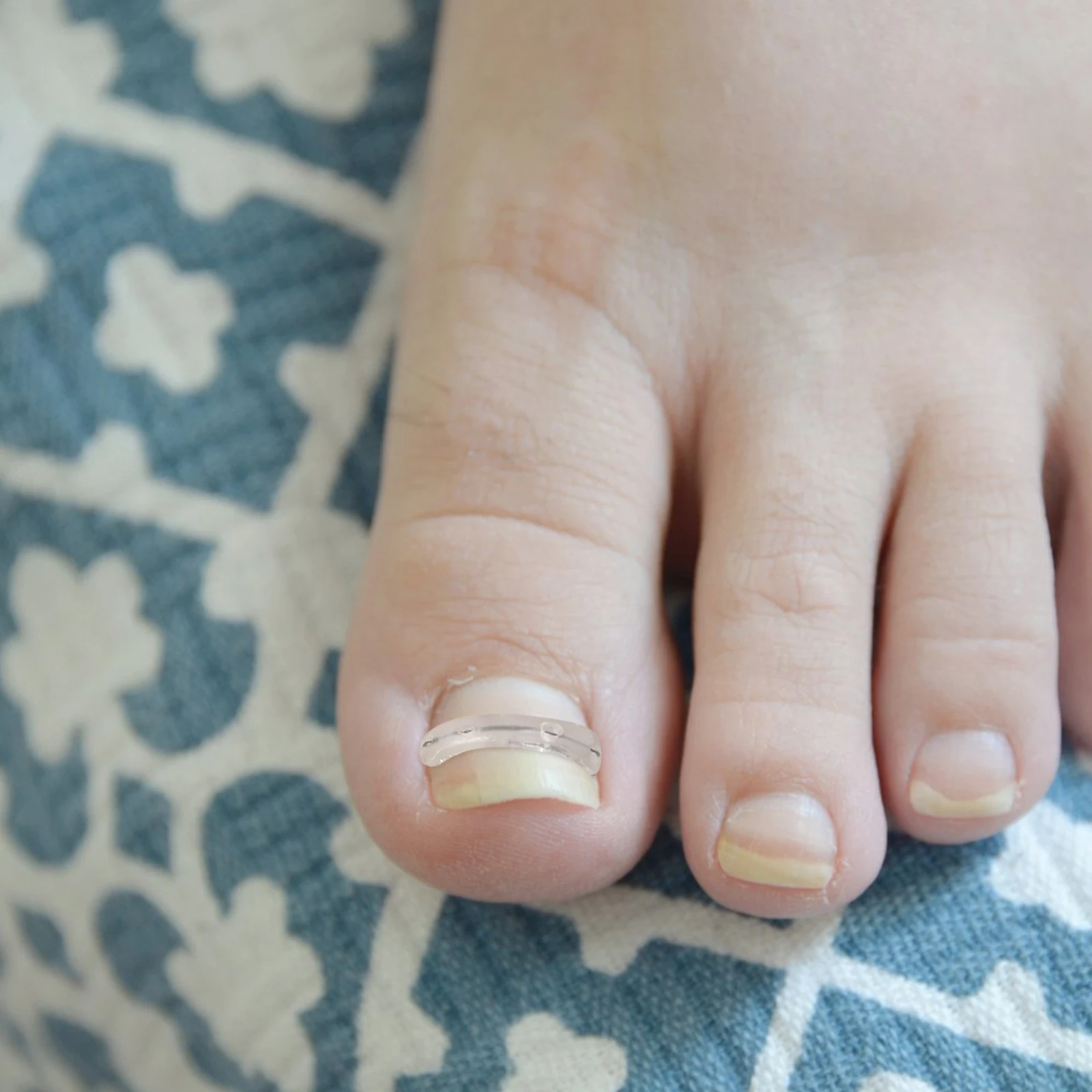 Toenail Corrector Strips Professional Household Nail Correction Tool For Ingrown Toenail Relief Reusable Small Toe Care