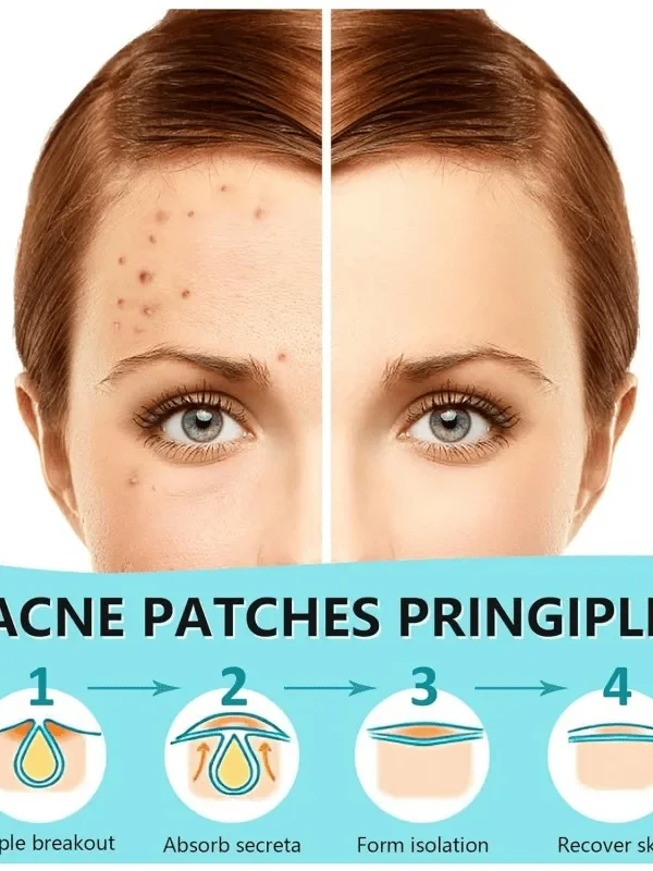 360 قطعة من رقع حب الشباب المستديرة بلون البشرة |   غرواني مائي وغطاء لطيف