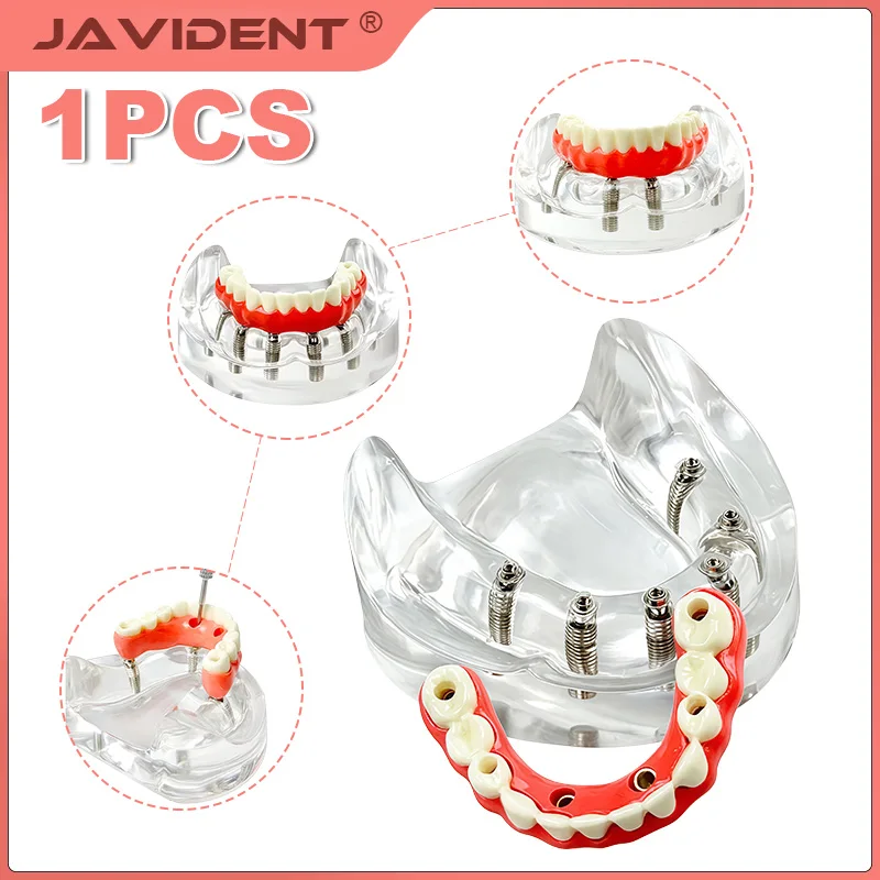 Dental Implant Teeth Model Overdenture Modle With 4/6 Removable Screws Transparent Upper Lower Jaw Type for Researching Medical