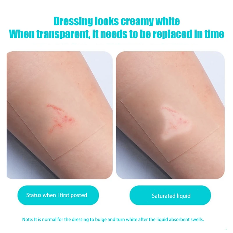 

Hydrocolloid Roll For Wound Care Hydrocolloid Patch Bandages With Self-Adhesive, Bed Sore Bandages, Highly Absorbent For Burn