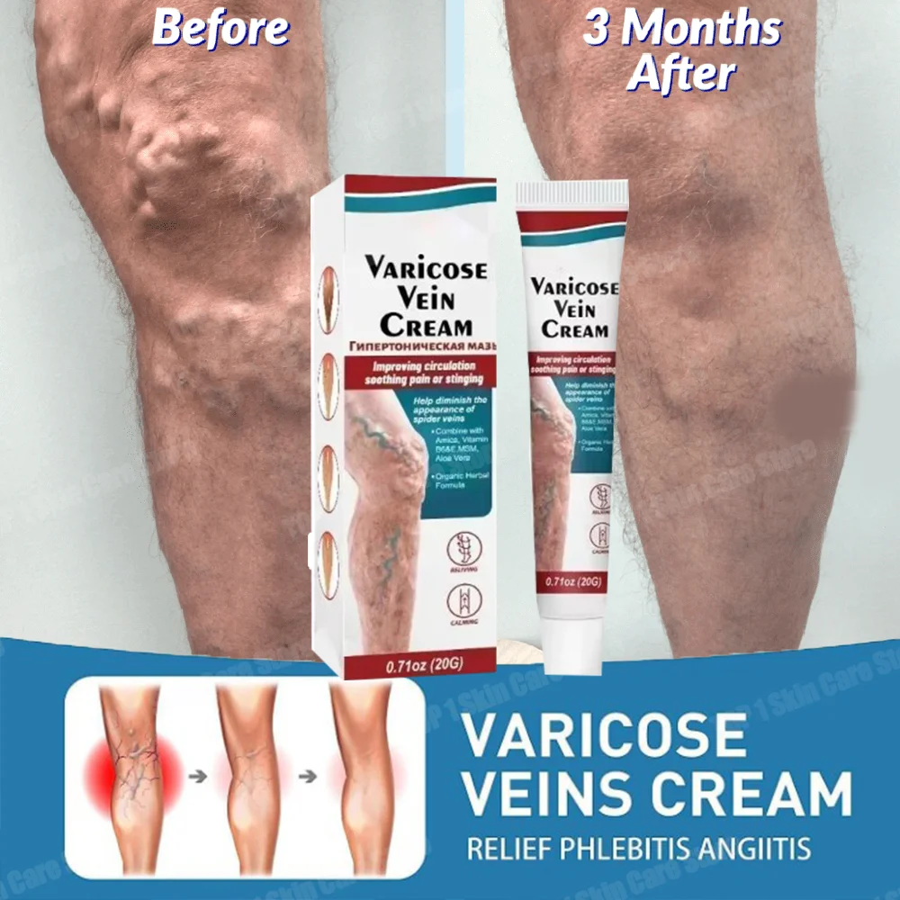 

Effective Varicose Vein Relief Ointment For Varicose Veins To Relieve Vasculitis Phlebitis Spider Pain