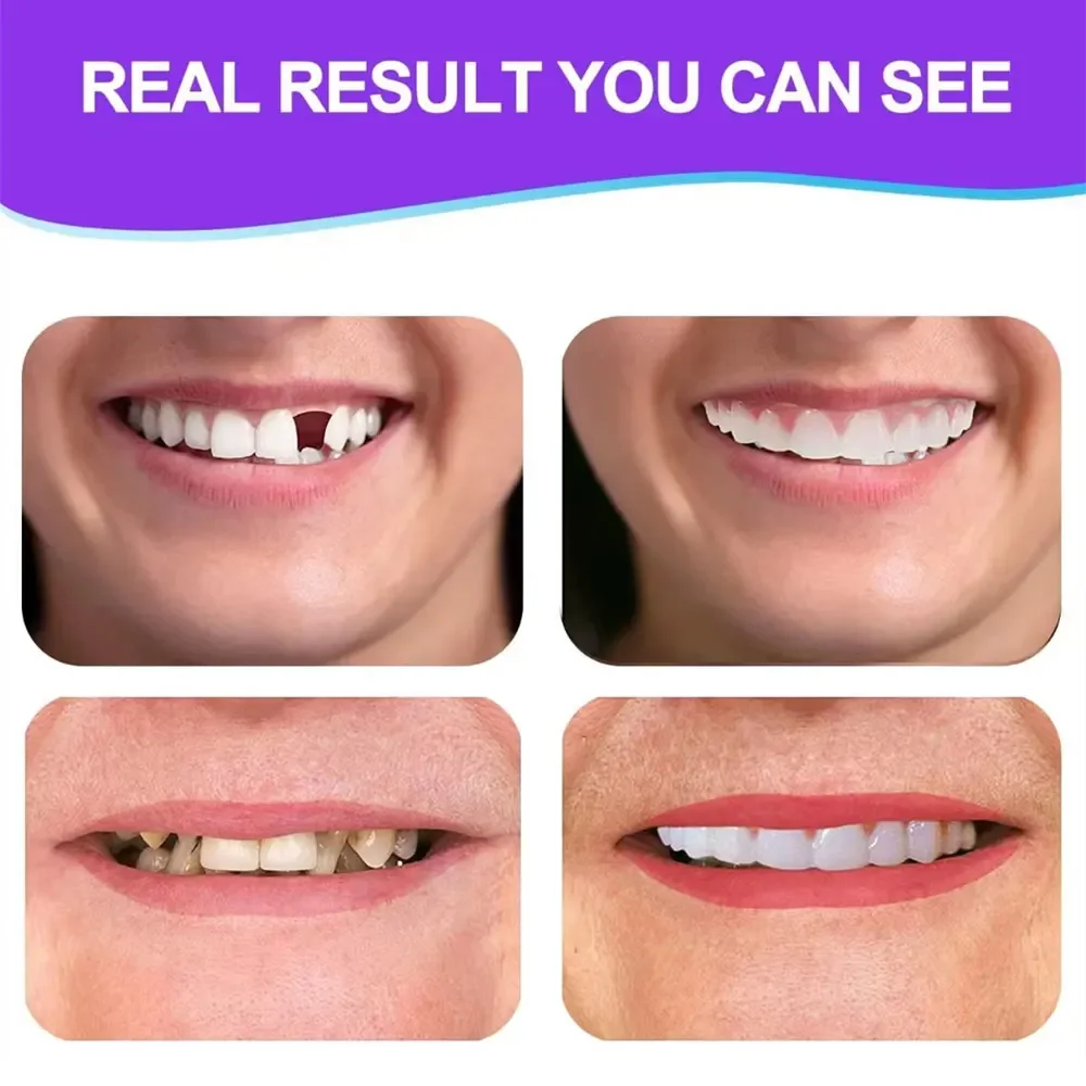 أطقم أسنان قابلة للتشكيل، أطقم أسنان قابلة للطي، مجموعة أسنان من السيليكون