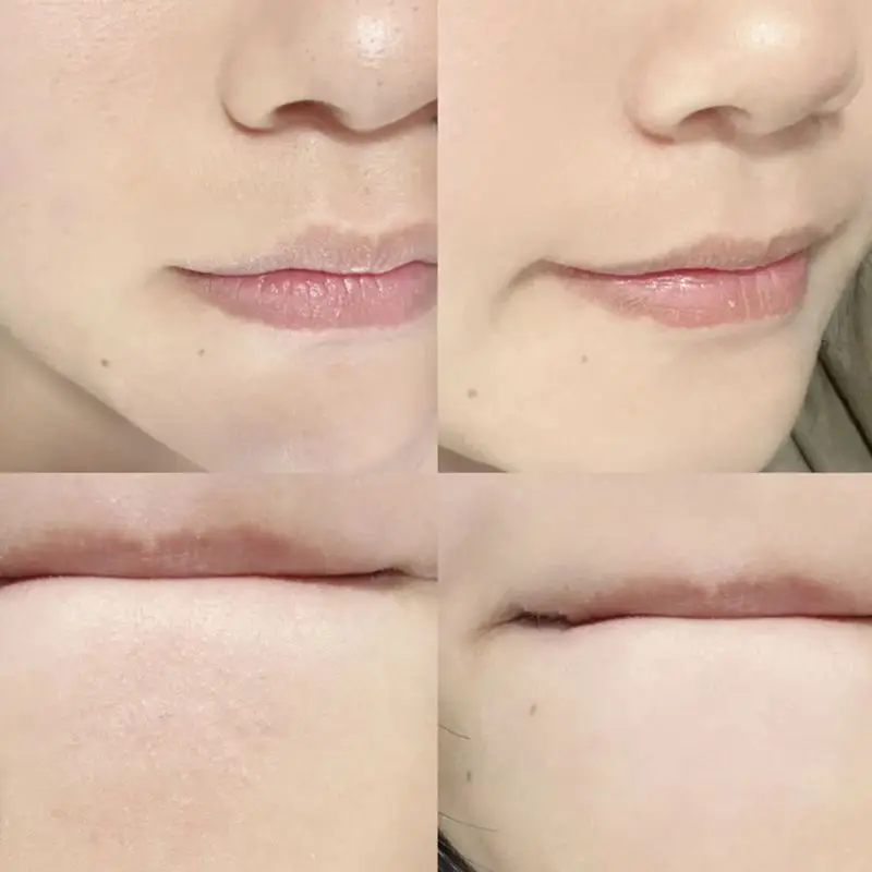 Dissolvant de points noirs ergonomique en acier inoxydable, outil de nettoyage de pores simple/double extrémité, extracteur de comédons pour le nez et le visage